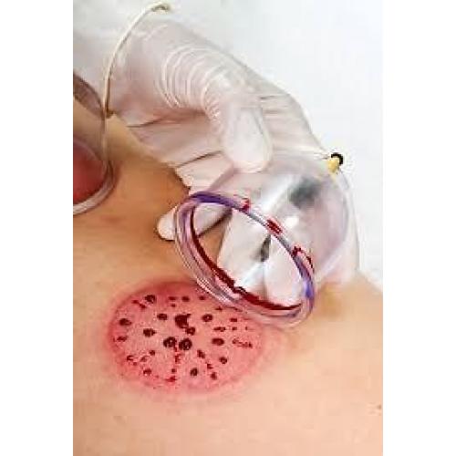 Hijama cupping in Oxford