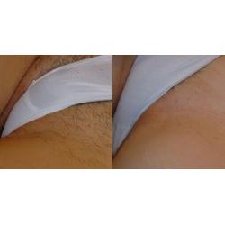 FULL BODY LASER HAIR REMOVAL 8 SESSIONS USUALLY ?999