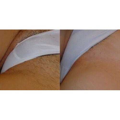 FULL BODY LASER HAIR REMOVAL 8 SESSIONS USUALLY ?999