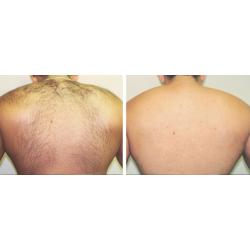 FULL BODY LASER HAIR REMOVAL 8 SESSIONS USUALLY ?999