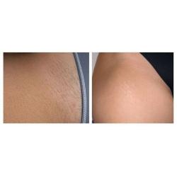 FULL BODY LASER HAIR REMOVAL 8 SESSIONS USUALLY ?999