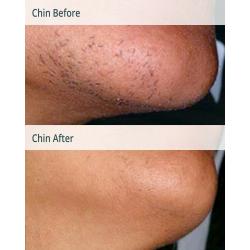FULL BODY LASER HAIR REMOVAL 8 SESSIONS USUALLY ?999